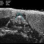 normal-thyroid-1.jpg
